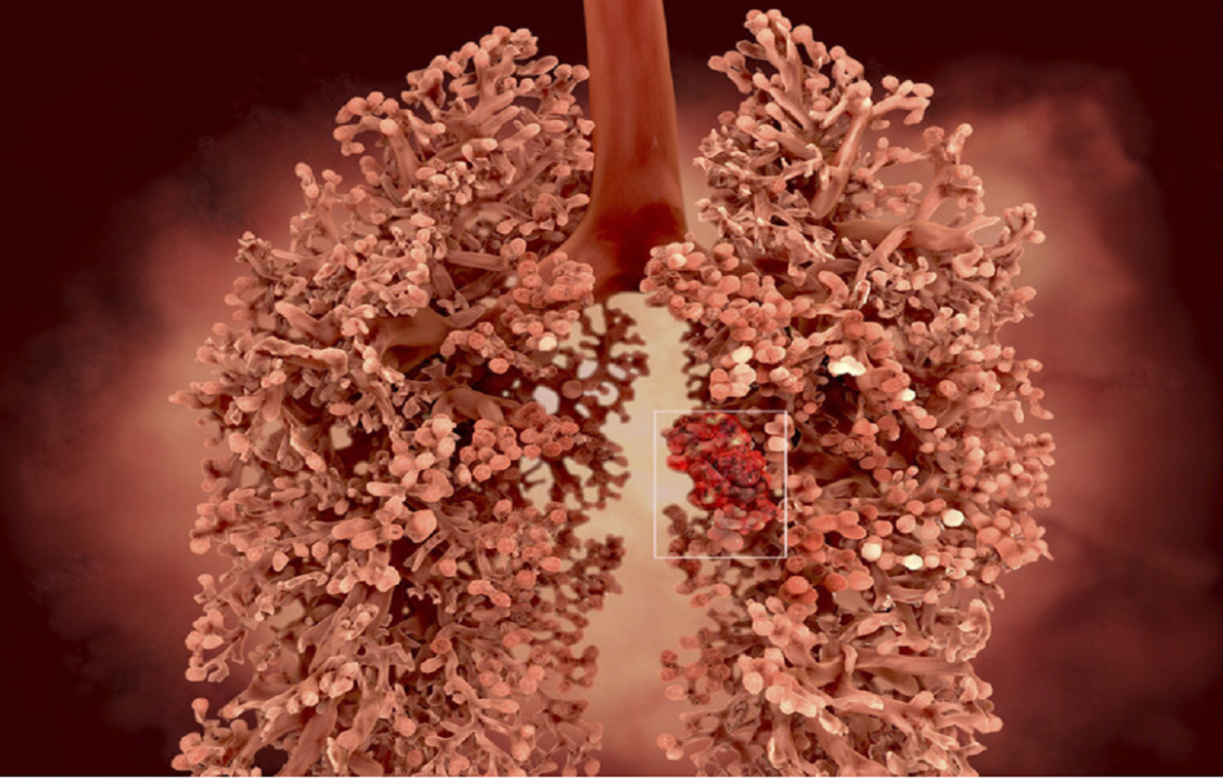 شناسایی یک داروی امیدبخش برای درمان یکی از تهاجمیترین سرطانها