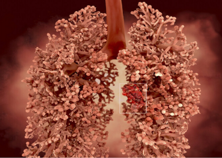 شناسایی یک داروی امیدبخش برای درمان یکی از تهاجمی‌ترین سرطان‌ها