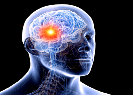 ابداع رویکردی جدید برای درمان یکی از تهاجمی‌ترین انواع سرطان مغز